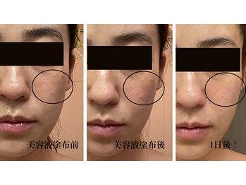 アイチューズ(ICHOOSE)/驚きのVC誘導体ケア！