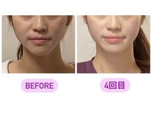 小顔22 ボルティ 赤坂支店(Bolty)/【悩み】面長・顎の長さ