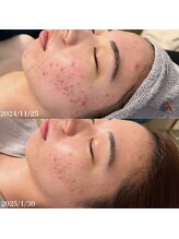 リリアス(RILLIAS)/ニキビケア