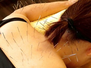 泰然の写真/「どこに行っても改善しない」「諦めている」など本気で不調を改善したい方にオススメの《ルート鍼》★