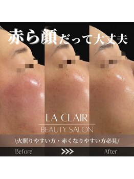 ラ クレール ビューティーサロン(LA CLAIR)/赤みへのアプローチ