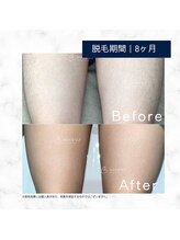 メンズクリア 武蔵小杉店/【メンズクリア】お客様の施術例