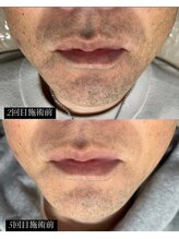 ベイビースキン(Baby skin)/ヒゲ脱毛 Before→After