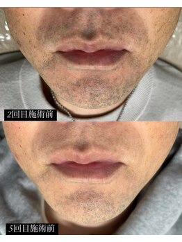 ベイビースキン(Baby skin)/ヒゲ脱毛 Before→After