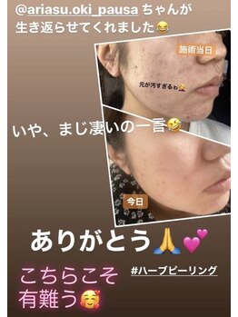 パウザ(PAUSA)/ハーブピーリング（ニキビケア）