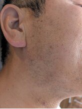 ブルーココア(BlueCocoa)/メンズヒゲ脱毛5回目