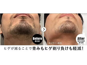 メンズ脱毛専門　RBLゆめタウン出雲店 【ヒゲ脱毛・全身脱毛・VIO】/メンズ脱毛/ヒゲ脱毛2回目剃毛後