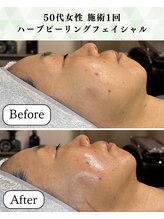 シーフェイス 横浜店(SEE FACE)/毛穴肌質改善ハーブピーリング