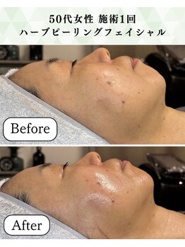 シーフェイス 横浜店(SEE FACE)/毛穴肌質改善ハーブピーリング