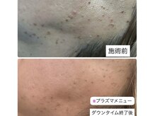 いやされサロン フー(fuu+)の雰囲気（イボケア放題20分3800円40分6500円!1回でこの効果!）