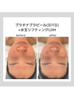 韓国肌管理室pom.haneul【ポムハヌル】LDM/インモード/ララピール/プラピール福岡天神/韓国肌管理室