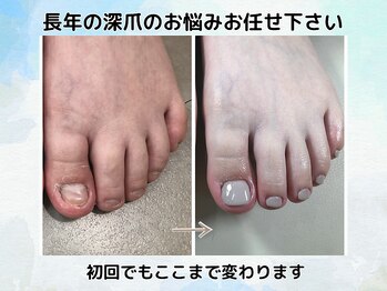 ブルームーンネイルズ(BLOOMOON.nails)の写真/【フットの深爪のお悩みに】その日のうちに見た目の変化を実感◎サンダルも楽しめる足元へ
