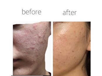 ナナラ(nanala)/肌質改善に!ルビーセル!