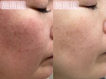 サロンドエテ(salon de ete)/赤ら顔改善