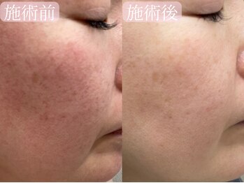 サロンドエテ(salon de ete)/赤ら顔改善