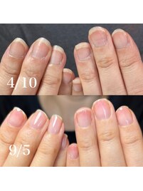 自爪育成/深爪育成/ネイルケア