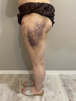 サロンシファ(salon sifa)/術後ケア