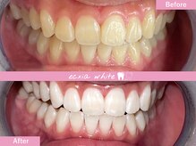 エクシアホワイトニング 札幌中島公園店/Before After［ホワイトニング］