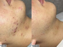 ドロップ 天王寺(DROP)/ハーブピーリング【ニキビケア】