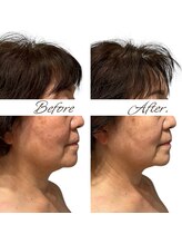 マヌレニ(manuleni)/下顔面&首あごまわりの引き締め