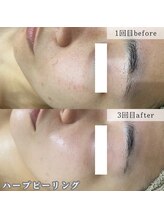 ネイルズビー 別邸(Nail's be)/毛穴/シミ/くすみ