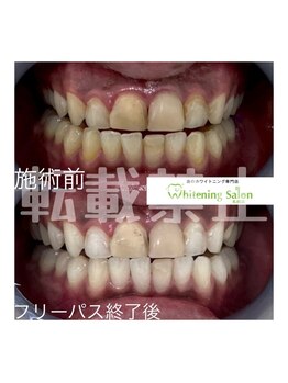 ホワイトニングサロン 札幌店/【ホワイトニング】#札幌#大通り