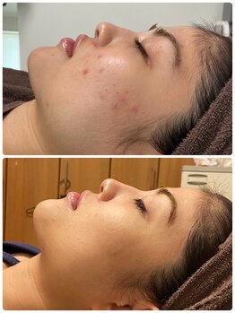 ミラヴィエ(Miravie)/肌質改善カスタマイズ10回