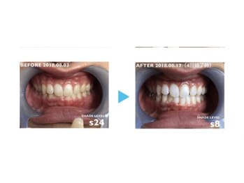 ミスターアンドミス脱毛専門店 難波店(Mr.&Ms.脱毛専門店)/セルフホワイトニング