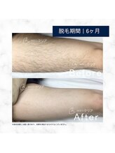 メンズクリア 武蔵小杉店/【メンズクリア】お客様の施術例
