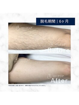 メンズクリア 武蔵小杉店/【メンズクリア】お客様の施術例