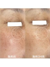 サロンドベルム(Salon de BELME)/シミケア経過：施術2回後