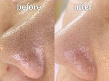 ラティエル(Latiele)/10年来の毛穴悩みに終止符を