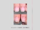 【自爪矯正】映 -utsu- | 