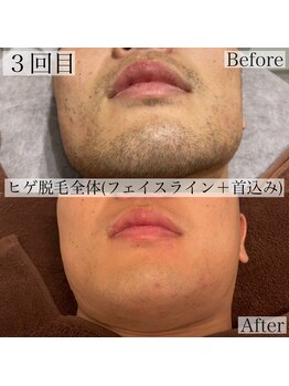 エステティックサロンR/ヒゲ脱毛♪3回目症例写真