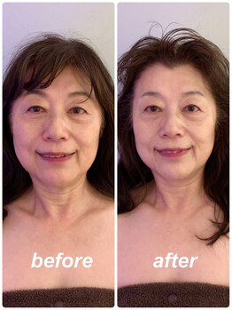 グッドライフエステ/Before＆Afterリフトアップ