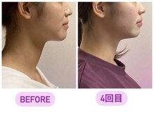 小顔22 ボルティ 赤坂支店(Bolty)/【悩み】面長・顎の長さ