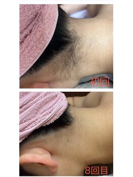 サロンドジェシカ(salon de Jessica)/うなじ脱毛/髪の毛