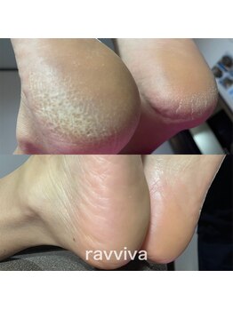 バナナ(Banana)/韓国式角質ケアエスプランニング