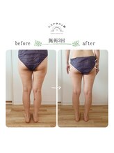 エステサロン朝/引き締め（太もも・ヒップ下）