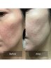【エステ版ポテンツァ】大人気韓国美容液アンプル使用で本気の肌質改善！