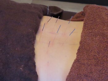 鍼灸整骨院わか/鍼で循環改善