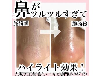 アルムダアクア 天王寺店(Aleumda AQUA)/毛穴エクストラクションプロ大阪