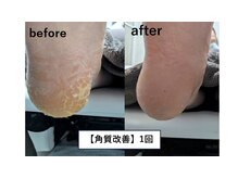 ネイルズ ヴォロンティエ(Nail's Volontiers)/角質除去