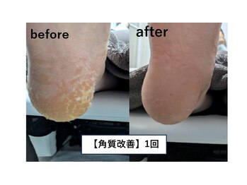 角質除去