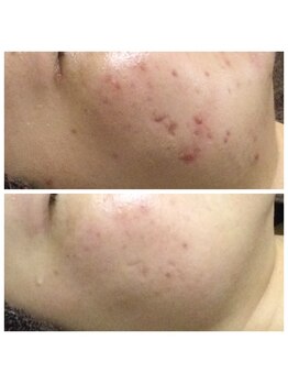 リラーナ(Re rana)/凹凸ニキビケア♪