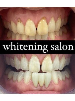 チェルト 鈴鹿店(CERTO)/歯のホワイトニング