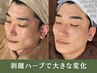 【剥離有り】高濃度幹細胞ハーブピーリング＋プラズマ　¥22,000→¥20,000