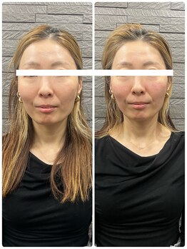 長寿鍼灸院 長寿整骨院/美容鍼50本の効果★小顔効果