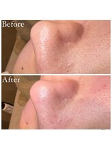 マドモアゼル 麻布十番/毛穴洗浄