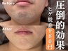 ※5名限定　圧倒的効果◎【メンズ脱毛/ヒゲ脱毛】ヒゲ全体88％OFF　7900→980